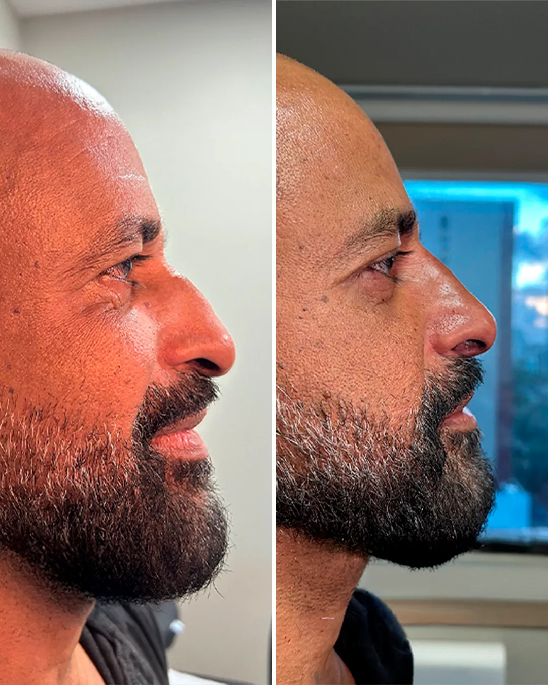 Antes e depois de rinomodelação sem cirurgia com o Dr. Flavio Werneque
