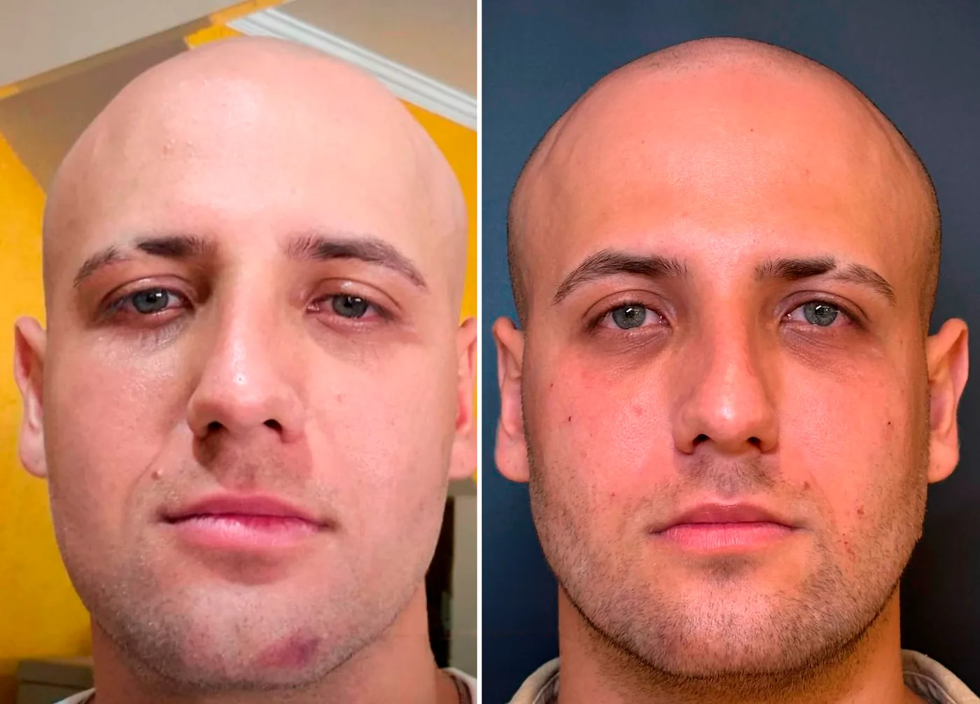 Antes e depois de harmonização facial com o Dr. Flavio Werneque